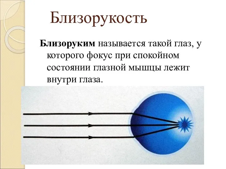 Близорукость Близоруким называется такой глаз, у которого фокус при спокойном состоянии глазной мышцы лежит внутри глаза.