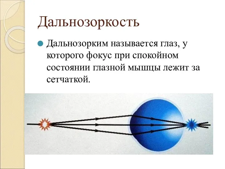 Дальнозоркость Дальнозорким называется глаз, у которого фокус при спокойном состоянии глазной мышцы лежит за сетчаткой.