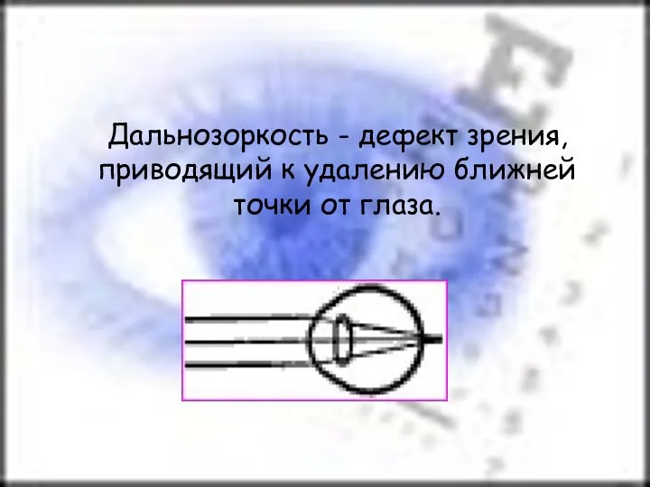 Дальнозоркость - дефект зрения, приводящий к удалению ближней точки от глаза.