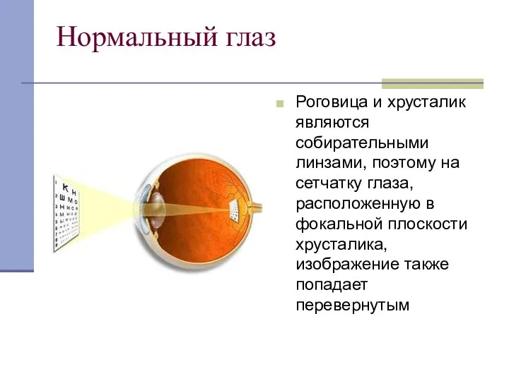 Нормальный глаз Роговица и хрусталик являются собирательными линзами, поэтому на сетчатку