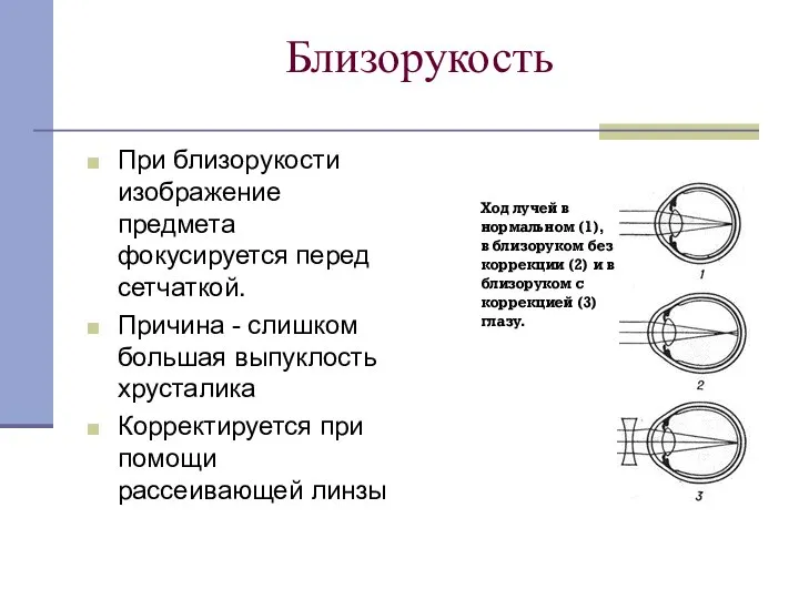 Близорукость При близорукости изображение предмета фокусируется перед сетчаткой. Причина - слишком