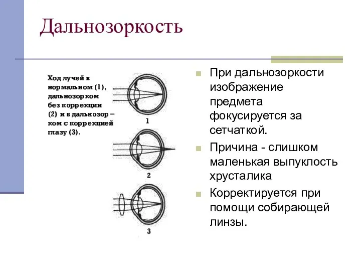 Дальнозоркость При дальнозоркости изображение предмета фокусируется за сетчаткой. Причина - слишком