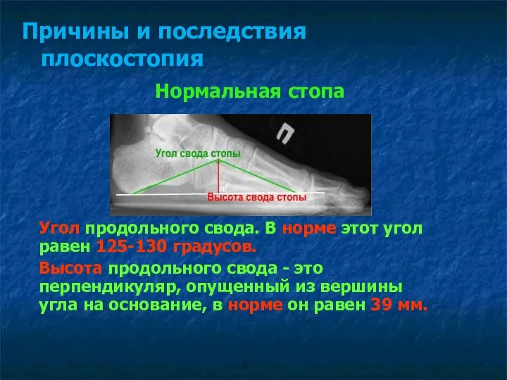 Нормальная стопа Причины и последствия плоскостопия Угол продольного свода. В норме