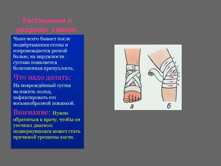 Растяжения и разрывы связок. Чаше всего бывает после подвёртывания стопы и