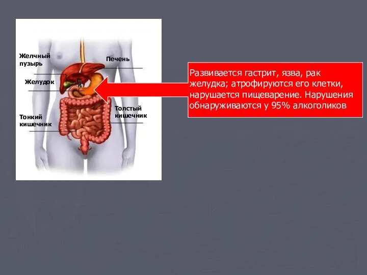 Печень Желчный пузырь Желудок Тонкий кишечник Толстый кишечник Развивается гастрит, язва,