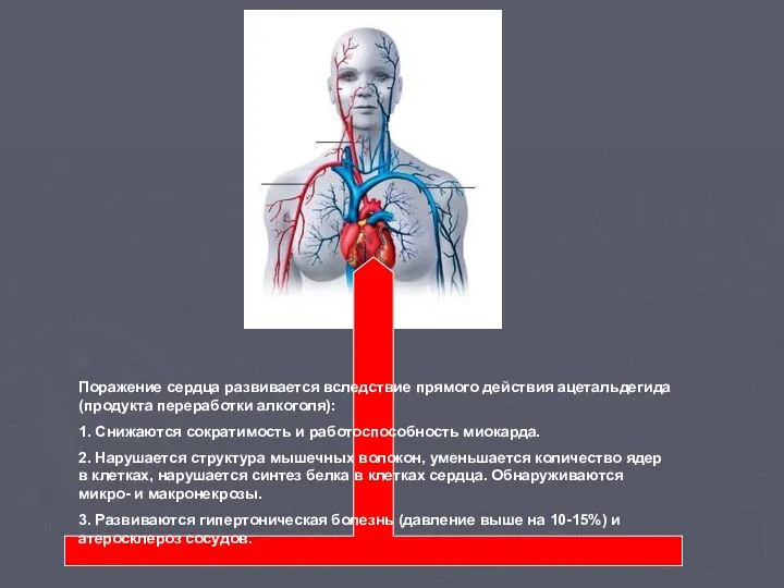 Поражение сердца развивается вследствие прямого действия ацетальдегида (продукта переработки алкоголя): 1.