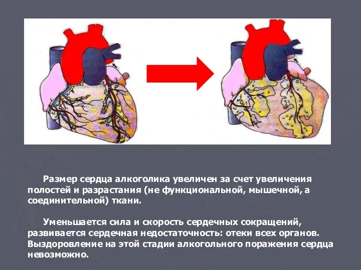 Размер сердца алкоголика увеличен за счет увеличения полостей и разрастания (не