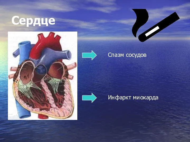 Сердце Спазм сосудов Инфаркт миокарда