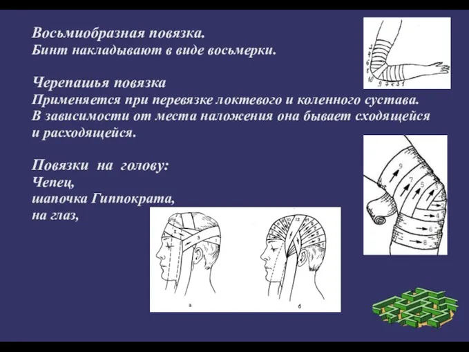 Восьмиобразная повязка. Бинт накладывают в виде восьмерки. Черепашья повязка Применяется при