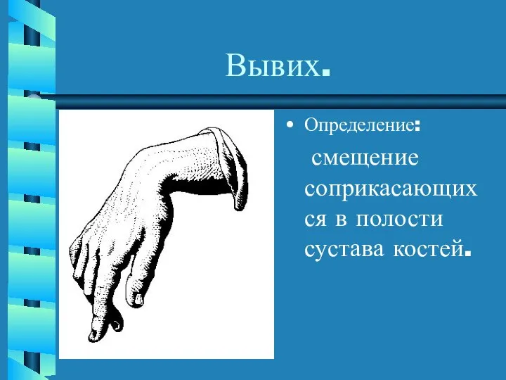 Вывих. Определение: смещение соприкасающихся в полости сустава костей.