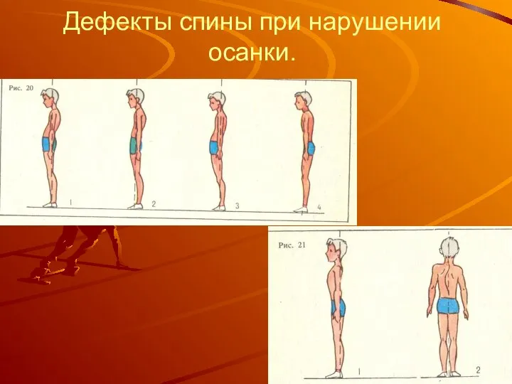 Дефекты спины при нарушении осанки.