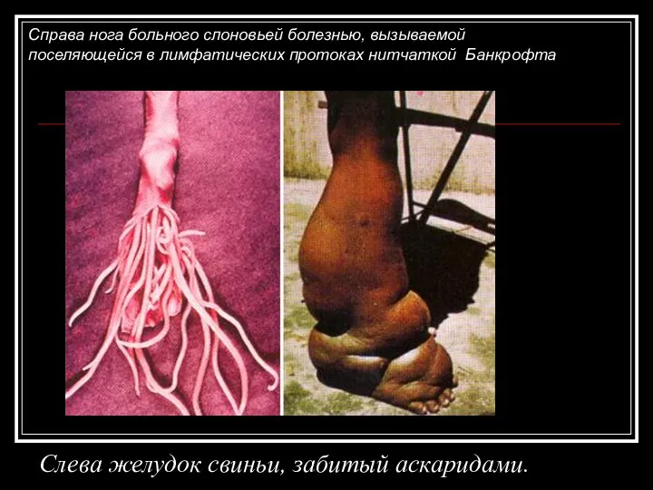 Слева желудок свиньи, забитый аскаридами. Справа нога больного слоновьей болезнью, вызываемой
