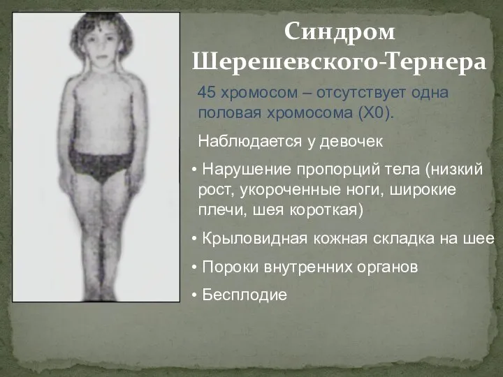 Синдром Шерешевского-Тернера 45 хромосом – отсутствует одна половая хромосома (Х0). Наблюдается