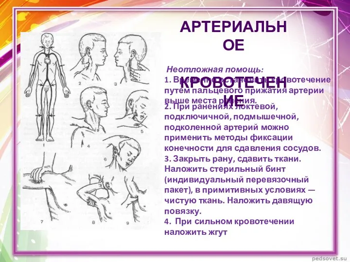 Неотложная помощь: 1. Временно остановить кровотечение путем пальцевого прижатия артерии выше