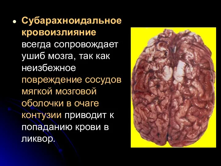 Субарахноидальное кровоизлияние всегда сопровождает ушиб мозга, так как неизбежное повреждение сосудов