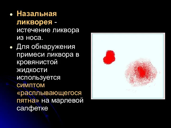 Назальная ликворея - истечение ликвора из носа. Для обнаружения примеси ликвора