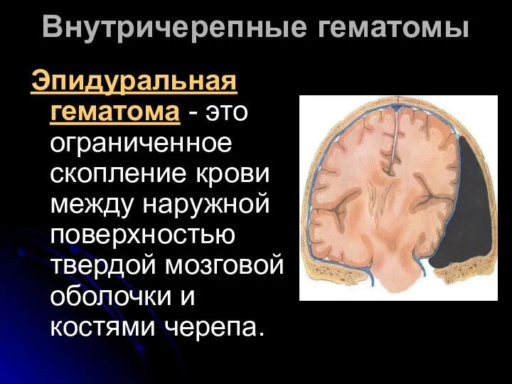 Эпидуральная гематома - это ограниченное скопление крови между наружной поверхностью твердой