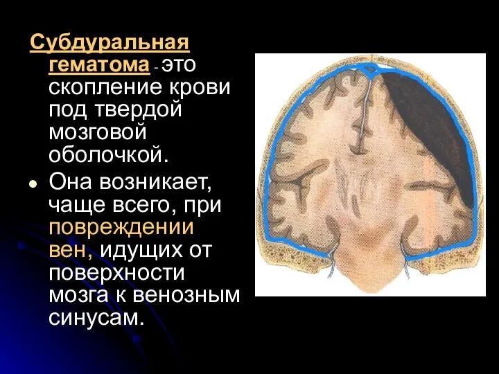 Субдуральная гематома - это скопление крови под твердой мозговой оболочкой. Она