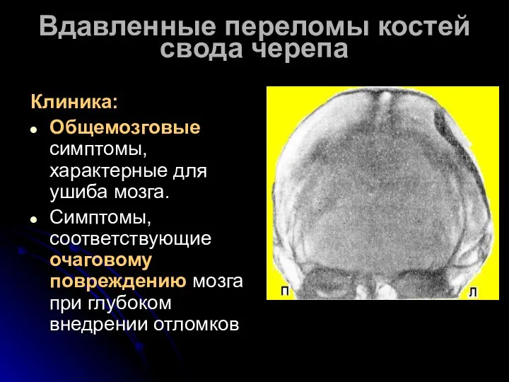 Вдавленные переломы костей свода черепа Клиника: Общемозговые симптомы, характерные для ушиба