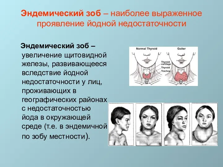 Эндемический зоб – наиболее выраженное проявление йодной недостаточности Эндемический зоб –