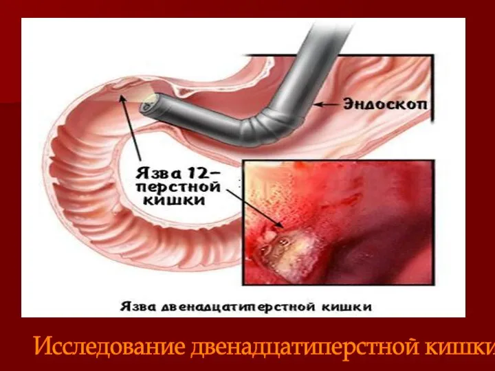 Исследование двенадцатиперстной кишки