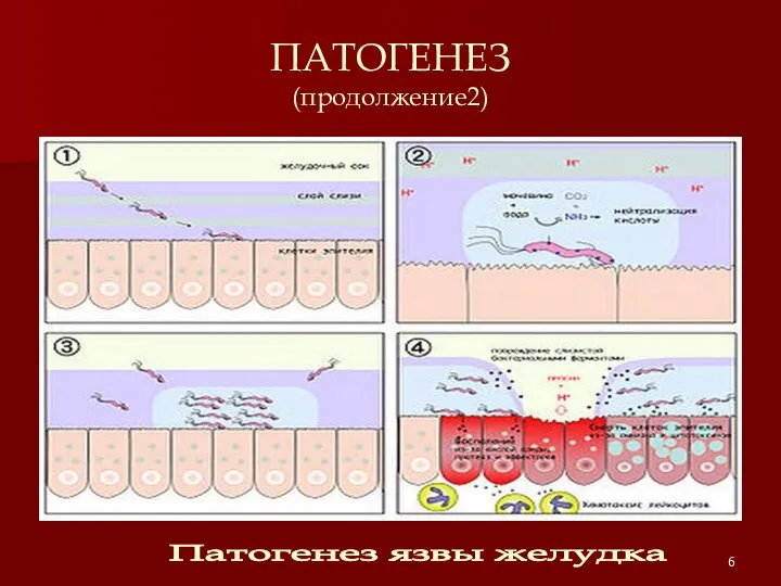 ПАТОГЕНЕЗ (продолжение2) Патогенез язвы желудка