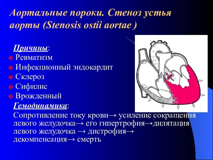 Аортальные пороки. Стеноз устья аорты (Stenosis ostii aortae ) Причины: Ревматизм