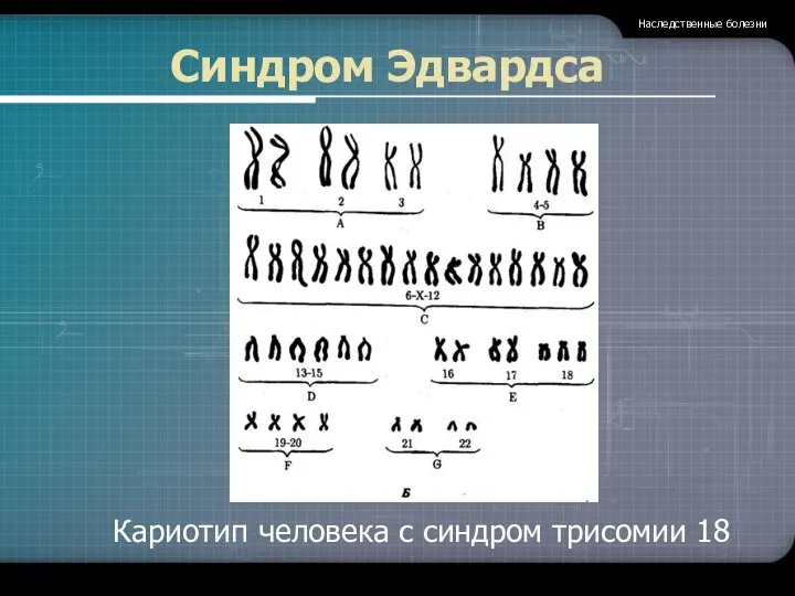 Синдром Эдвардса Наследственные болезни Кариотип человека с синдром трисомии 18