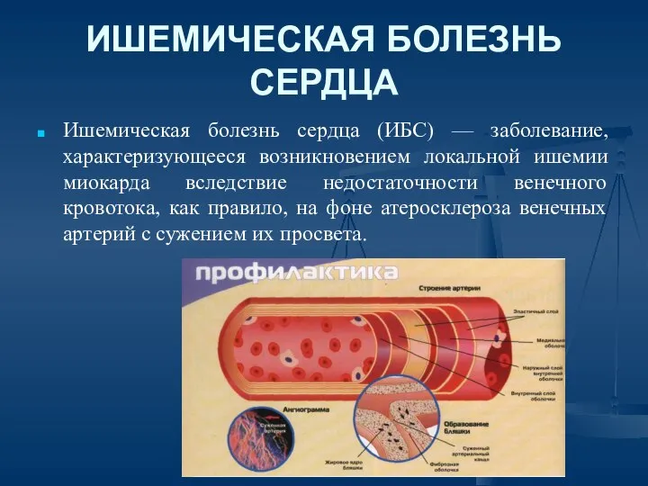 ИШЕМИЧЕСКАЯ БОЛЕЗНЬ СЕРДЦА Ишемическая болезнь сердца (ИБС) — заболевание, характеризующееся возникновением