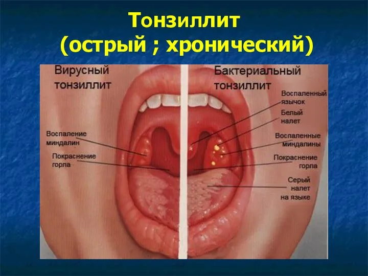 Тонзиллит (острый ; хронический)