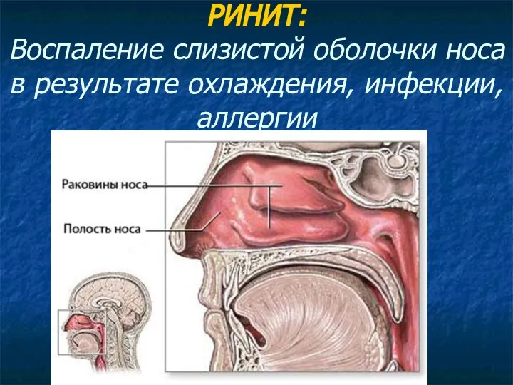 РИНИТ: Воспаление слизистой оболочки носа в результате охлаждения, инфекции, аллергии