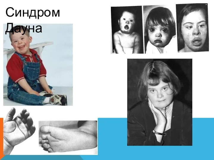 Синдром Дауна