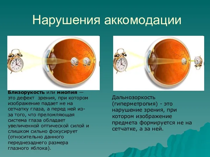 Нарушения аккомодации Дальнозоркость (гиперметропия) - это нарушение зрения, при котором изображение