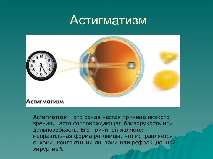 Астигматизм Астигматизм - это самая частая причина низкого зрения, часто сопровождающая