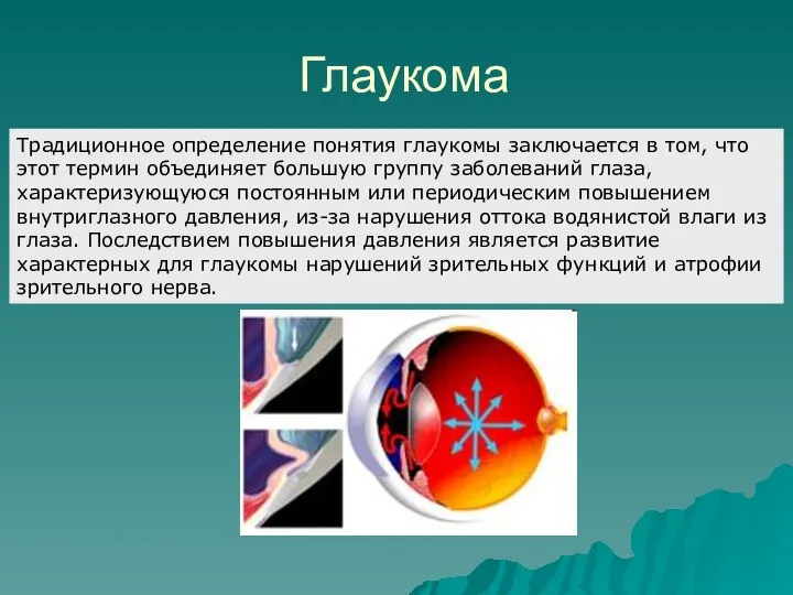 Глаукома Традиционное определение понятия глаукомы заключается в том, что этот термин