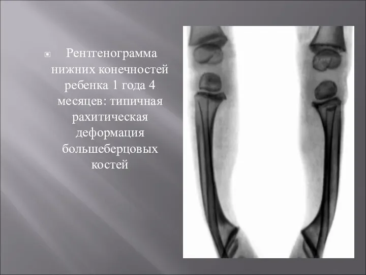 Рентгенограмма нижних конечностей ребенка 1 года 4 месяцев: типичная рахитическая деформация большеберцовых костей