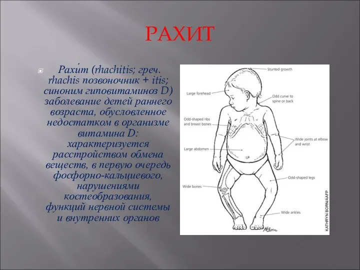 РАХИТ Рахи́т (rhachitis; греч. rhachis позвоночник + itis; синоним гиповитаминоз D)