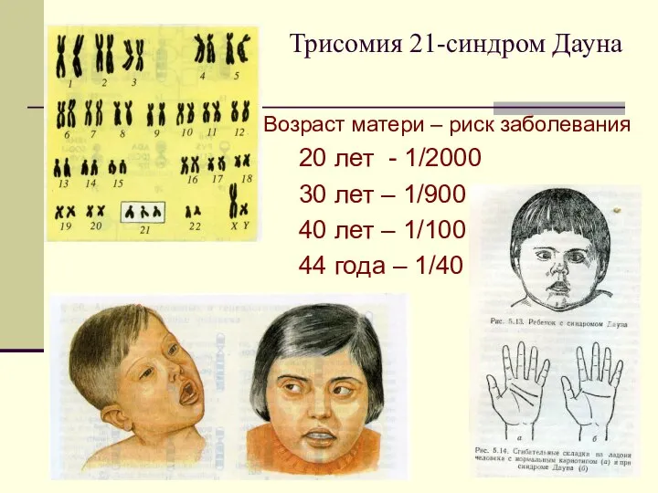 Трисомия 21-синдром Дауна Возраст матери – риск заболевания 20 лет -