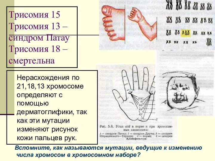 Трисомия 15 Трисомия 13 – синдром Патау Трисомия 18 – смертельна