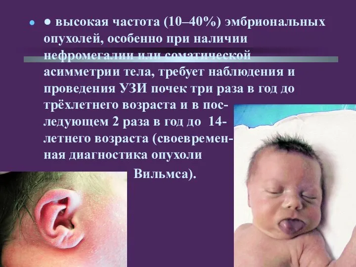 ● высокая частота (10–40%) эмбриональных опухолей, особенно при наличии нефромегалии или