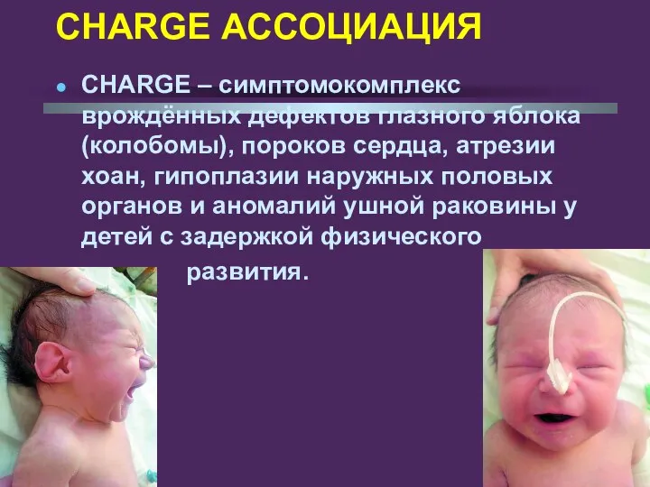 CHARGE АССОЦИАЦИЯ СHARGE – симптомокомплекс врождённых дефектов глазного яблока (колобомы), пороков