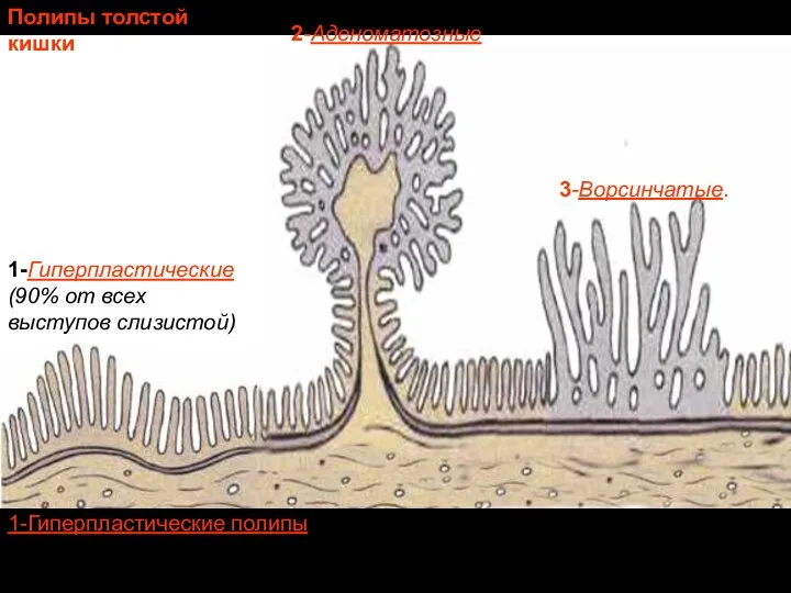 1-Гиперпластические (90% от всех выступов слизистой) 2-Аденоматозные 3-Ворсинчатые. Полипы толстой кишки
