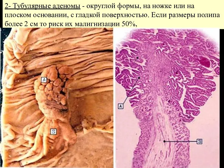 2- Тубулярные аденомы - округлой формы, на ножке или на плоском