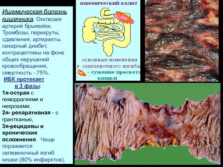 Ишемическая болезнь кишечника. Окклюзия артерий брыжейки. Тромбозы, перекруты, сдавления, артерииты. сахарный