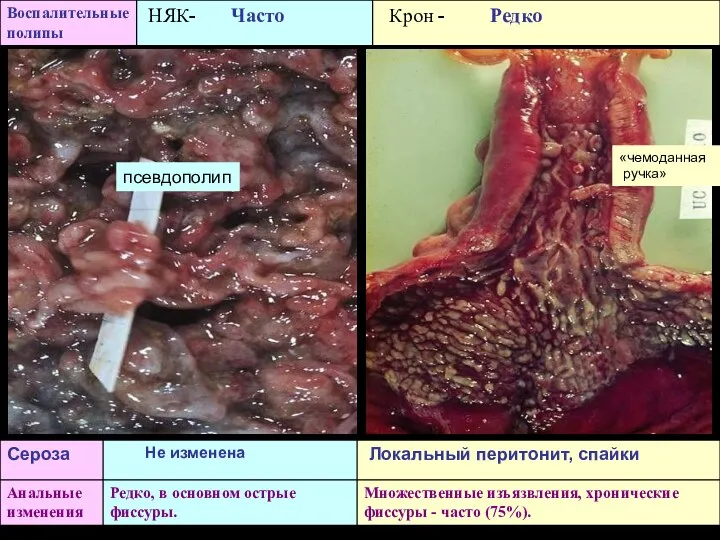 «чемоданная ручка» псевдополип