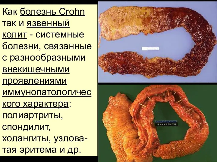 Как болезнь Crohn так и язвенный колит - системные болезни, связанные