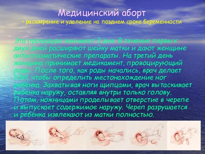 Медицинский аборт – расширение и удаление на позднем сроке беременности Эта