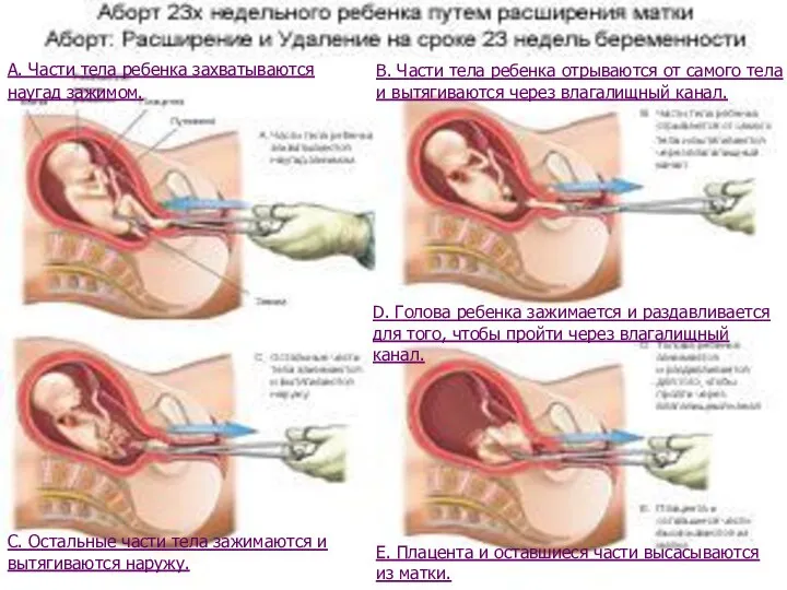 А. Части тела ребенка захватываются наугад зажимом. В. Части тела ребенка