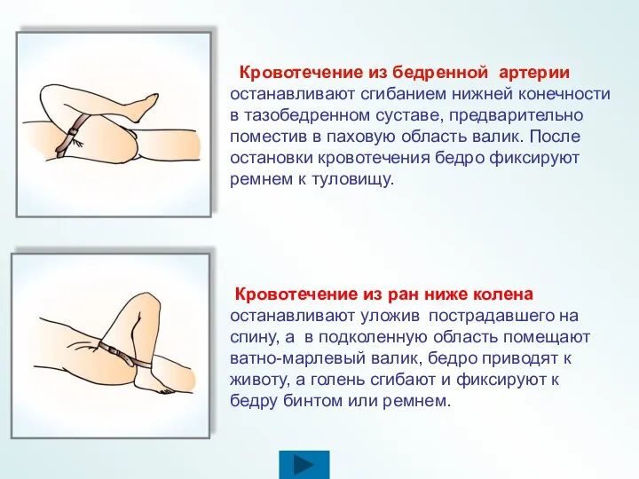 Кровотечение из бедренной артерии останавливают сгибанием нижней конечности в тазобедренном суставе,