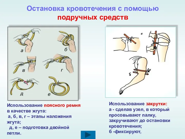 Остановка кровотечения с помощью подручных средств Использование поясного ремня в качестве